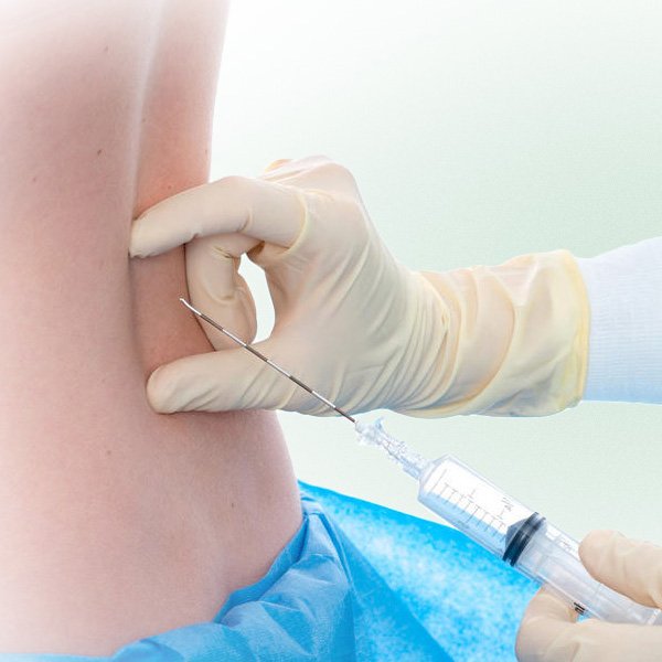 Close-up of a medical professional administering an epidural injection into a patient’s lower back during labor